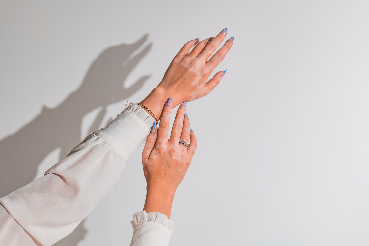Manicured Hands with Vitiligo